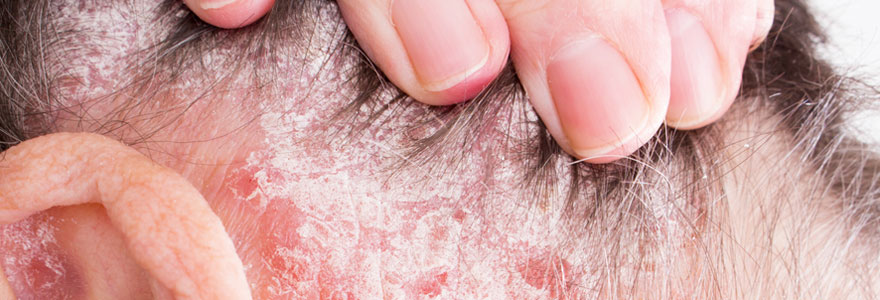 Bien s'informer sur le psoriasis